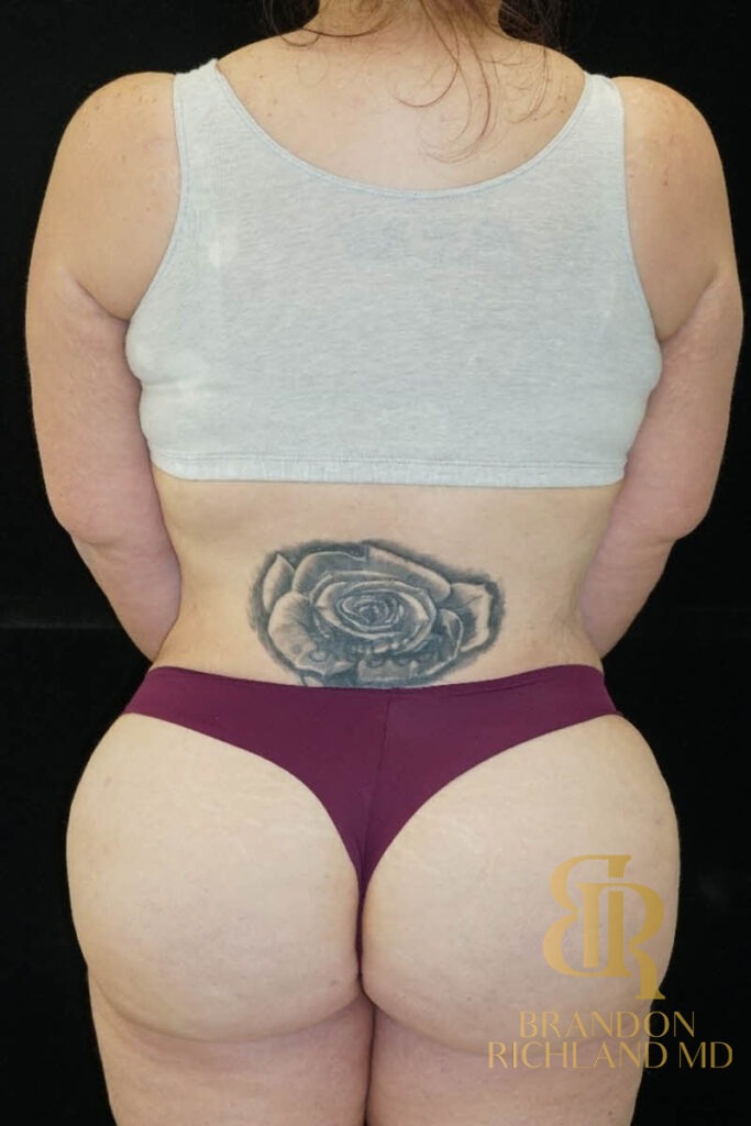 BBL After photo, Patient 01