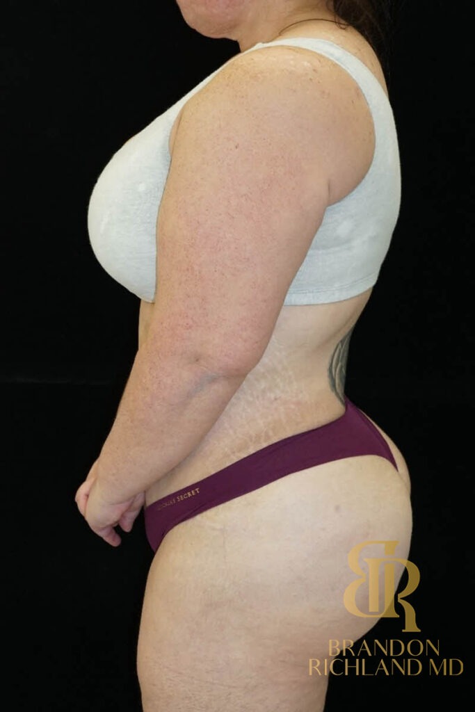 BBL After photo, Patient 01