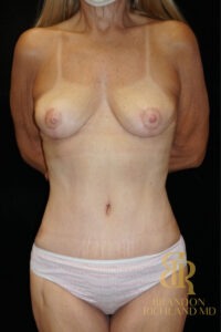 Body Contouring before and after, Patient 03 — Dr. Brandon Richland, Newport Beach