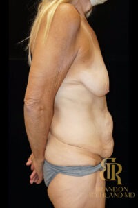 Body Contouring before and after, Patient 03 — Dr. Brandon Richland, Newport Beach