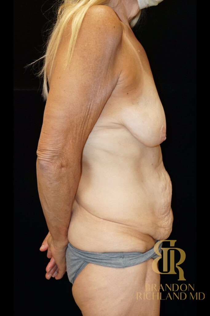 Body Contouring Before, Patient 03, view 3 — Dr. Brandon Richland, Newport Beach