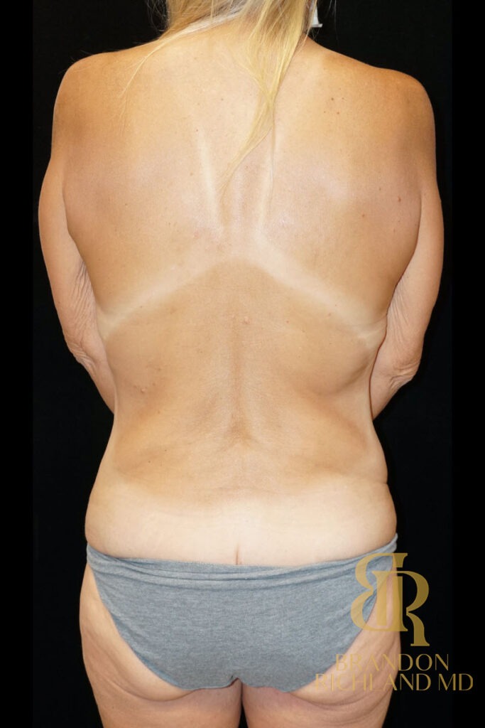 Body Contouring Before, Patient 03, view 4 — Dr. Brandon Richland, Newport Beach