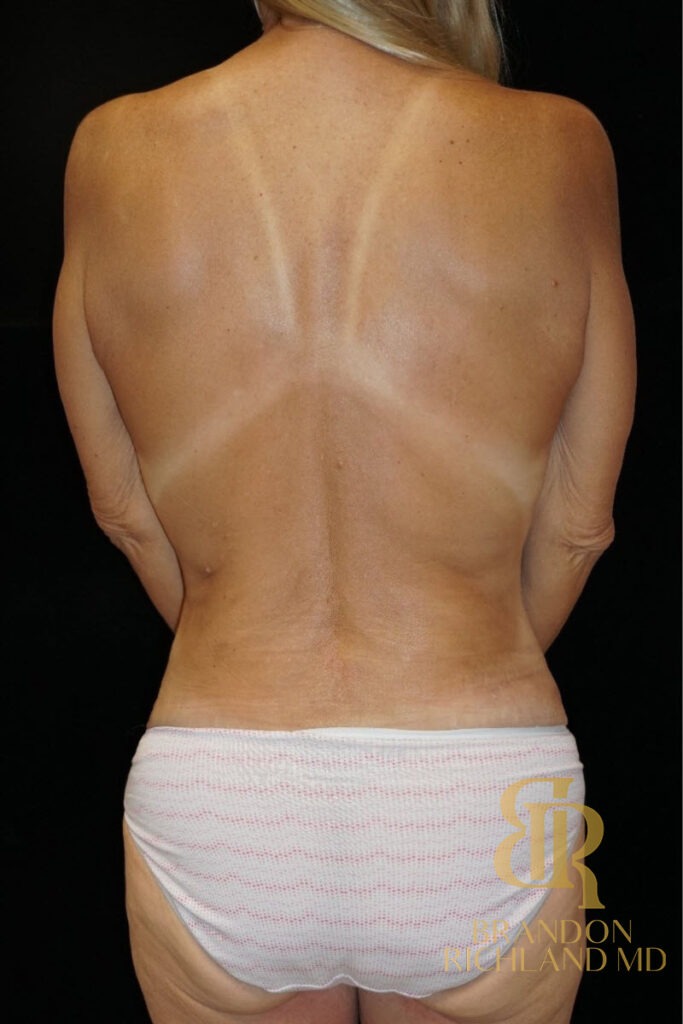 Body Contouring After, Patient 03, view 4 — Dr. Brandon Richland, Newport Beach