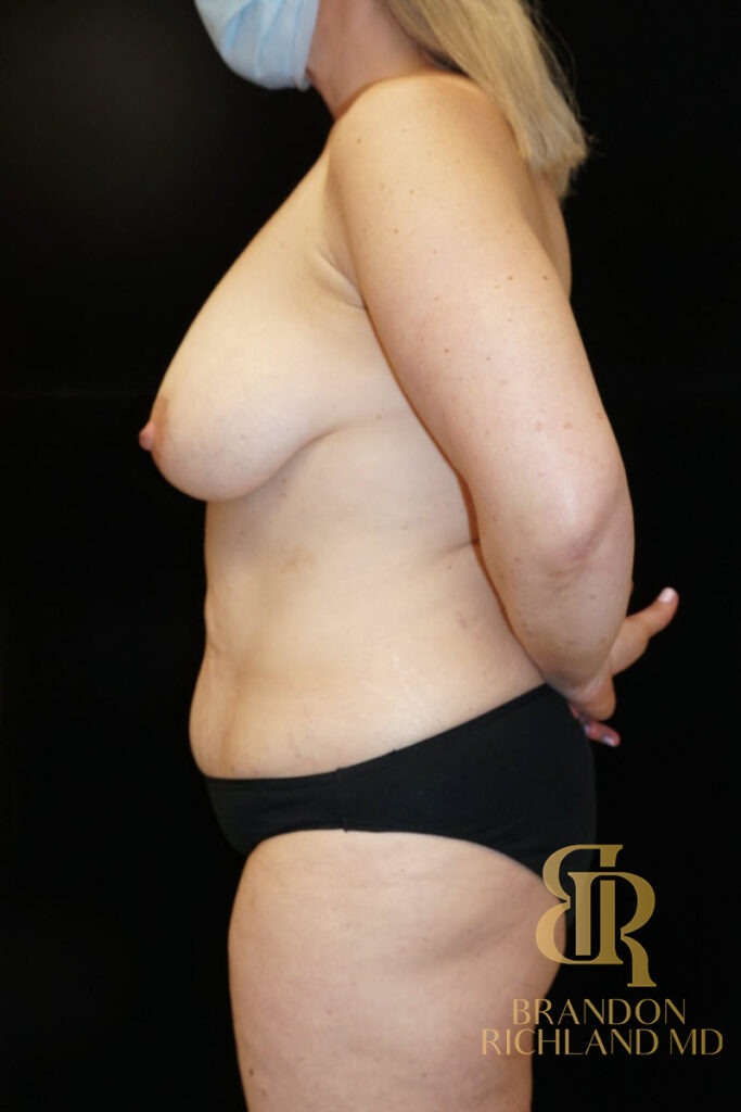 Body Contouring Before, Patient 04, view 5 — Dr. Brandon Richland, Newport Beach