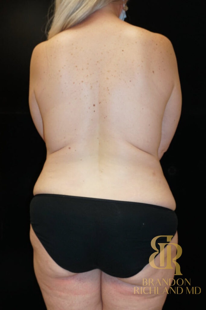 Body Contouring Before, Patient 04, view 6 — Dr. Brandon Richland, Newport Beach