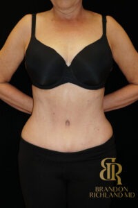 Body Contouring before and after, Patient 05 — Dr. Brandon Richland, Newport Beach