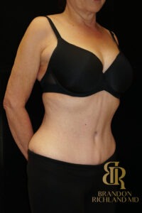Body Contouring before and after, Patient 05 — Dr. Brandon Richland, Newport Beach