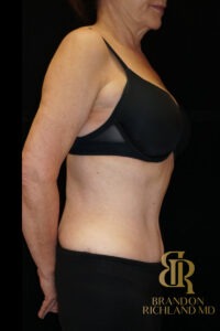 Body Contouring before and after, Patient 05 — Dr. Brandon Richland, Newport Beach
