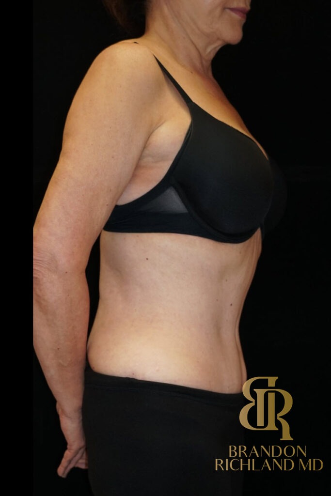 Body Contouring After, Patient 05, view 3 — Dr. Brandon Richland, Newport Beach
