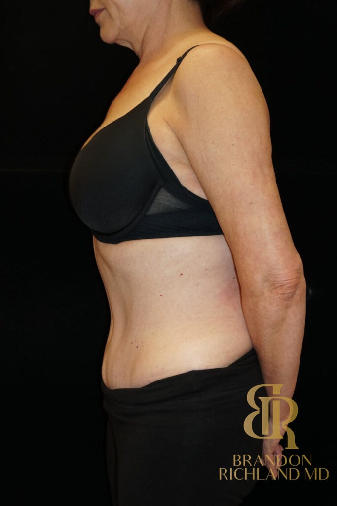 Body Contouring After, Patient 05, view 5 — Dr. Brandon Richland, Newport Beach