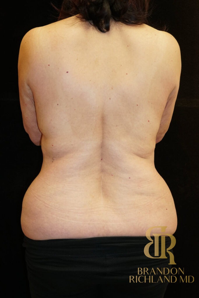 Body Contouring Before, Patient 05, view 6 — Dr. Brandon Richland, Newport Beach
