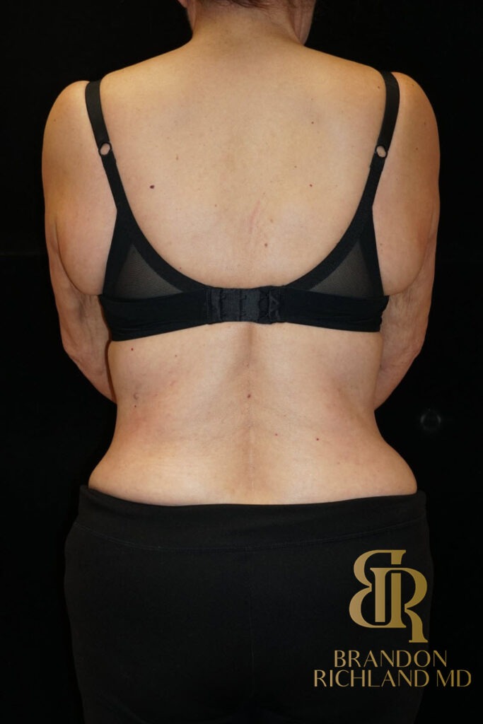 Body Contouring After, Patient 05, view 6 — Dr. Brandon Richland, Newport Beach