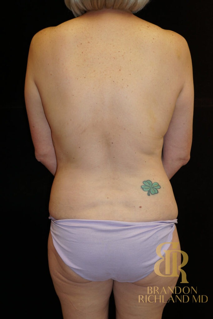 Body Contouring Before, Patient 07, view 6 — Dr. Brandon Richland, Newport Beach