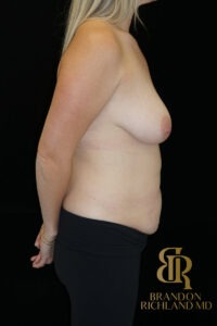Body Contouring before and after, Patient 08 — Dr. Brandon Richland, Newport Beach