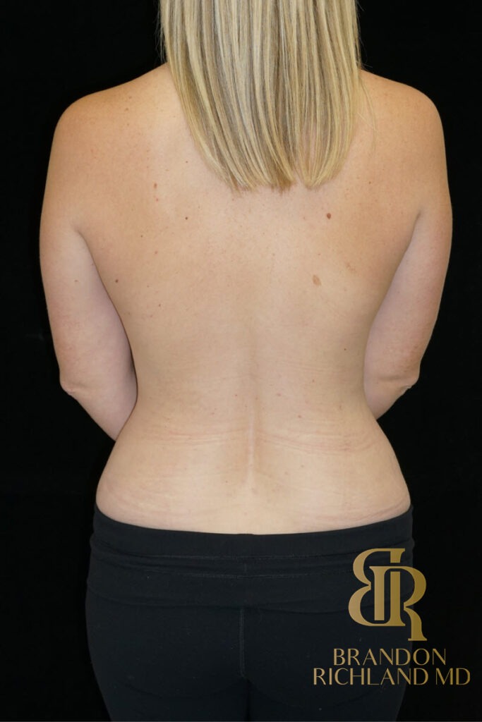 Body Contouring After, Patient 08, view 6 — Dr. Brandon Richland, Newport Beach