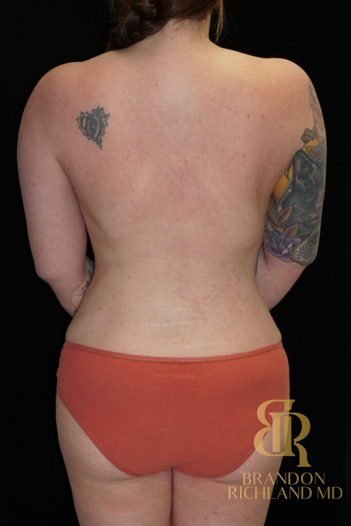 Body Contouring After, Patient 10, view 6 — Dr. Brandon Richland, Newport Beach