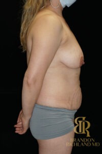 Body Contouring before and after, Patient 11 — Dr. Brandon Richland, Newport Beach