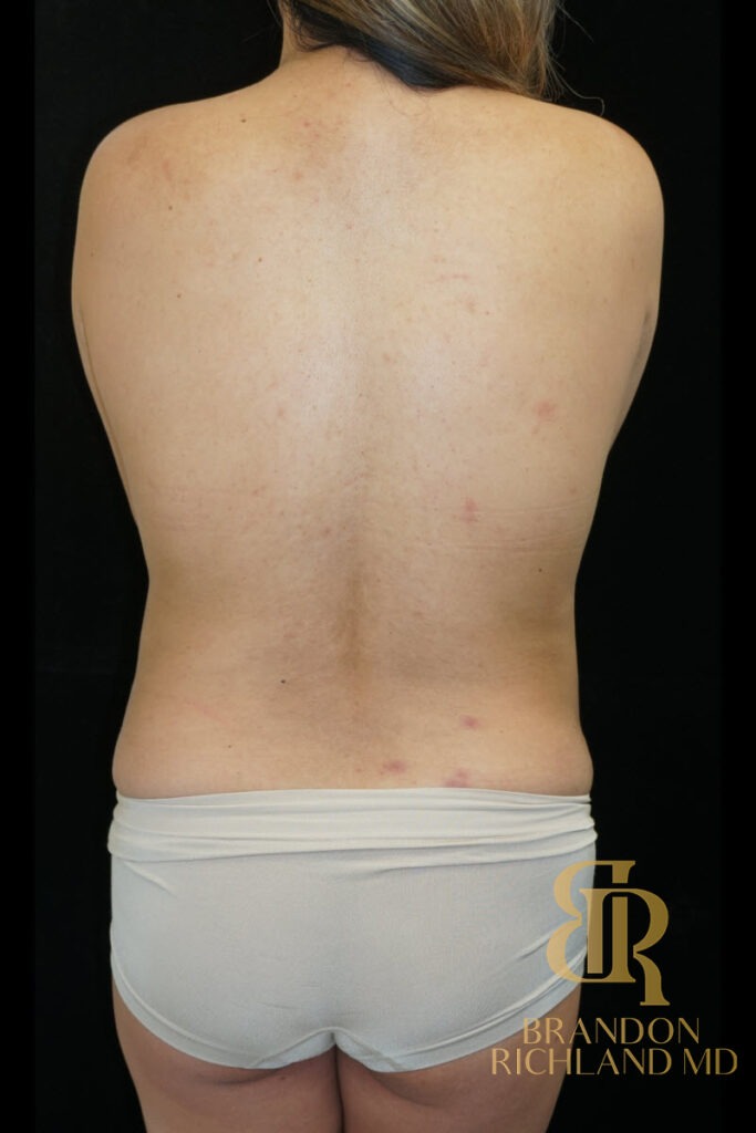 Body Contouring Before, Patient 12, view 6 — Dr. Brandon Richland, Newport Beach