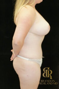 Body Contouring before and after, Patient 15 — Dr. Brandon Richland, Newport Beach