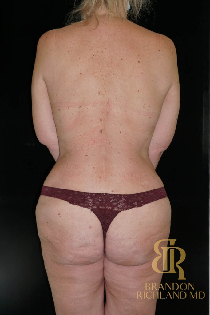 Body Contouring After, Patient 17, view 6 — Dr. Brandon Richland, Newport Beach