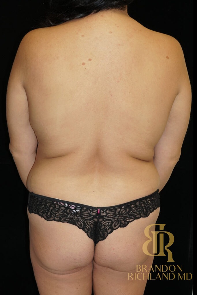 Body Contouring Before, Patient 18, view 6 — Dr. Brandon Richland, Newport Beach