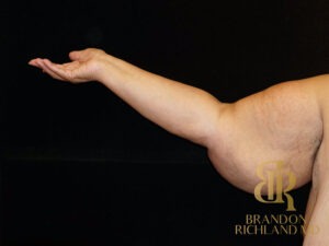 Arm Lift before and after, Patient 01 — Dr. Brandon Richland, Newport Beach
