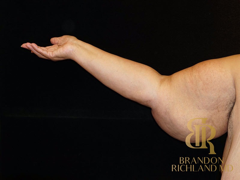 Arm Lift Before photo, Patient 01