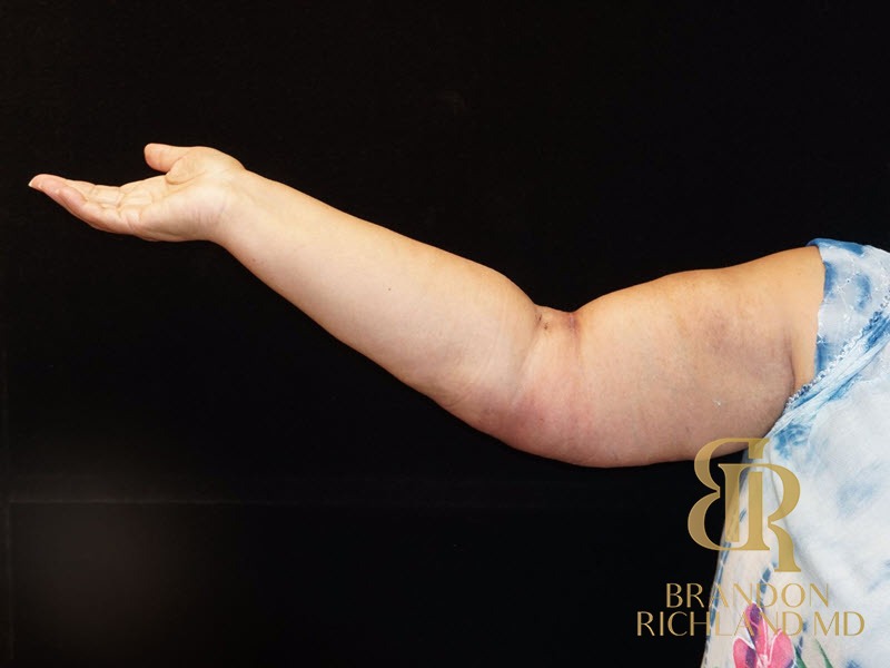 Arm Lift After photo, Patient 01