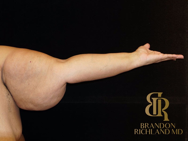 Arm Lift Before photo, Patient 01