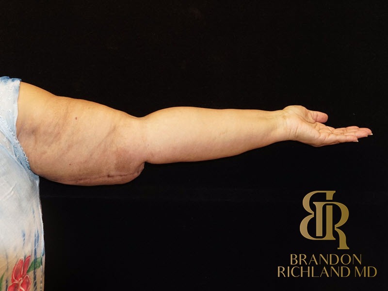 Arm Lift After photo, Patient 01