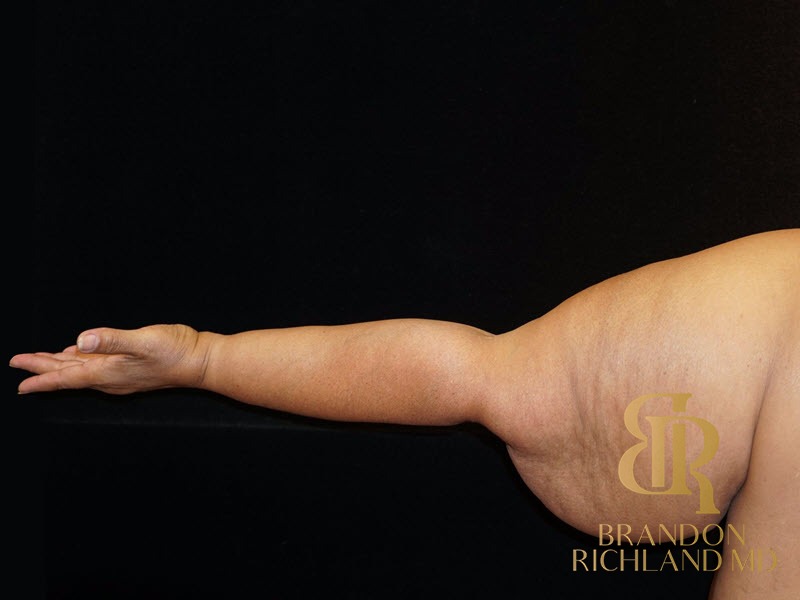 Arm Lift Before photo, Patient 01