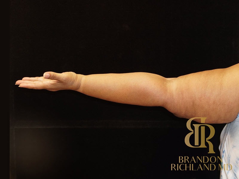 Arm Lift After photo, Patient 01