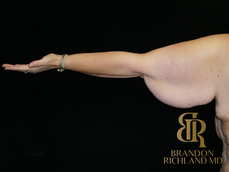 Arm Lift Before photo, Patient 02