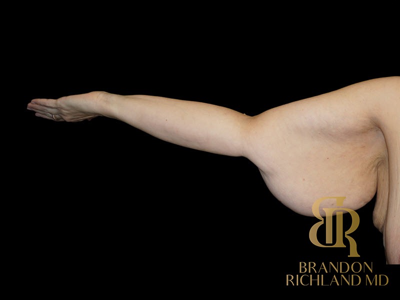 Arm Lift Before photo, Patient 02