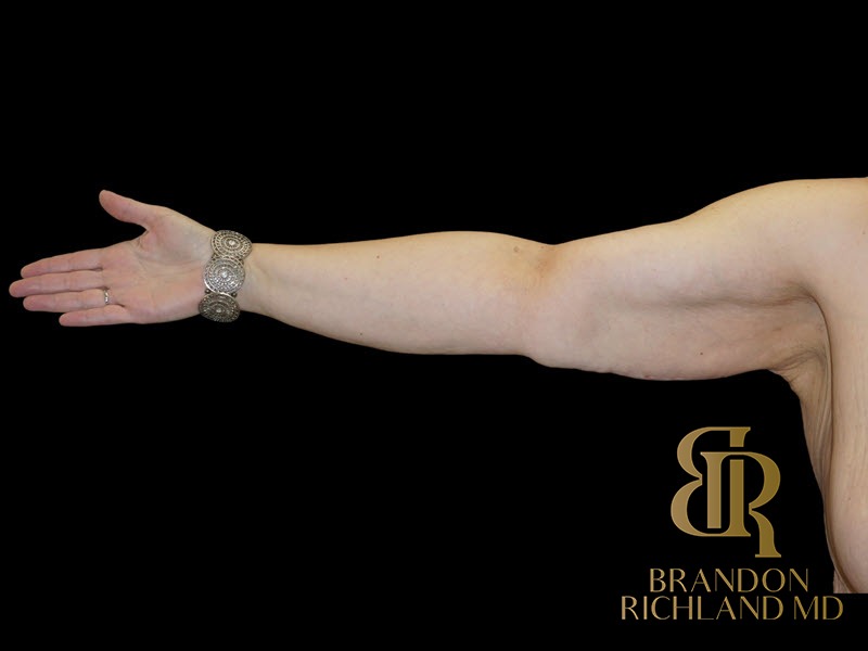 Arm Lift After photo, Patient 02