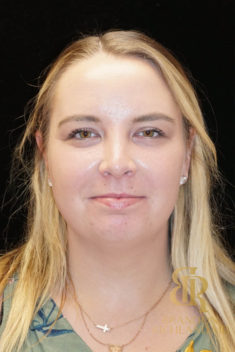 Liposuction before and after, Patient 02 — Dr. Brandon Richland, Newport Beach