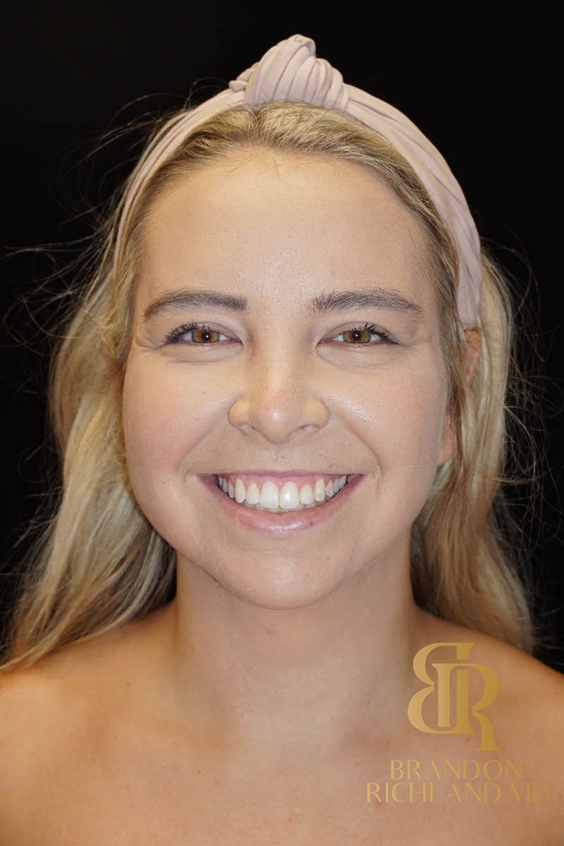 Liposuction before and after, Patient 02 — Dr. Brandon Richland, Newport Beach