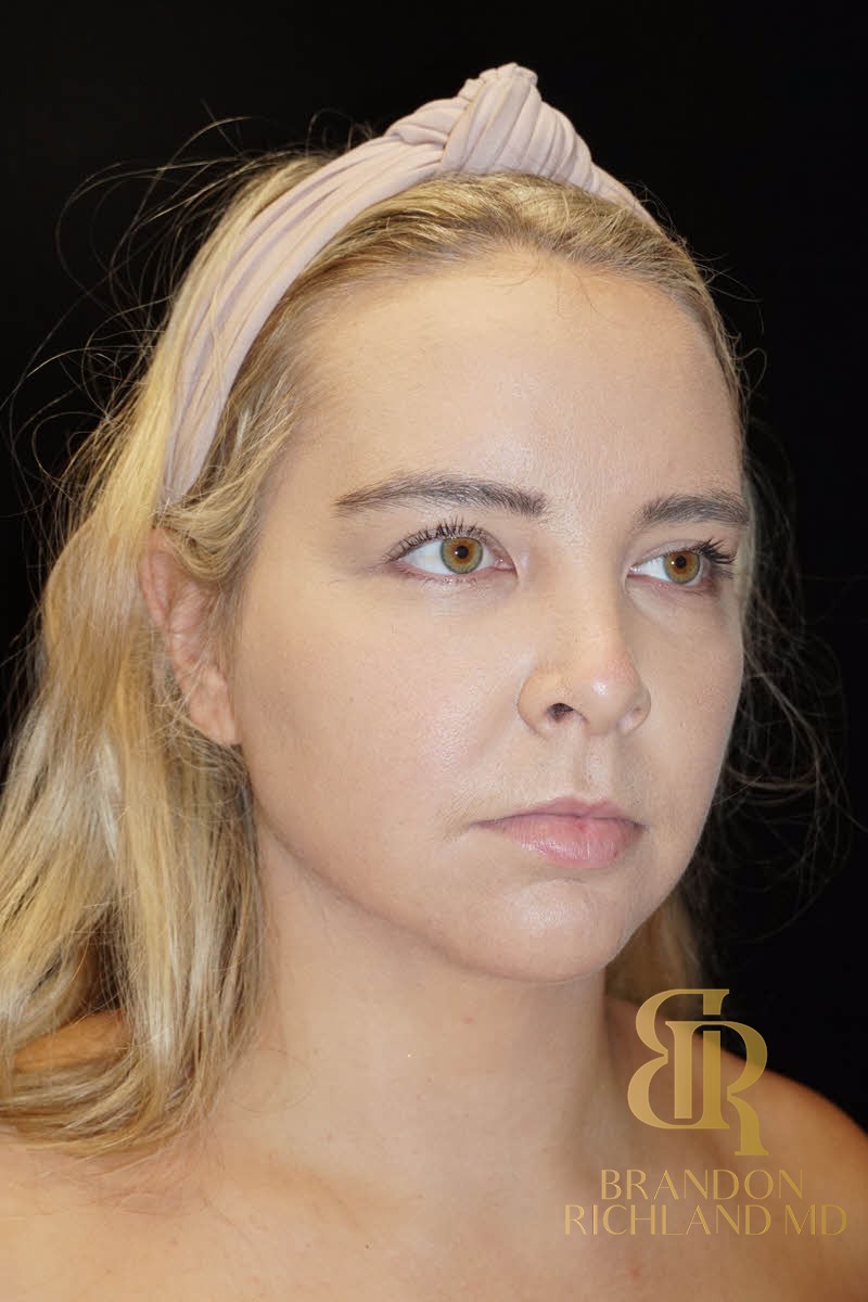 Liposuction before and after, Patient 02 — Dr. Brandon Richland, Newport Beach