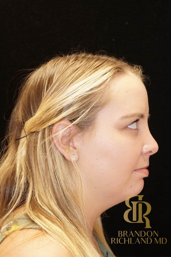 Liposuction Before, Patient 02, view 3 — Dr. Brandon Richland, Newport Beach