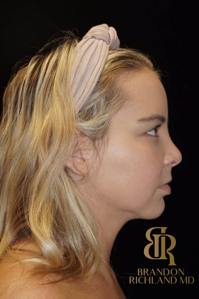 Liposuction After, Patient 02, view 3 — Dr. Brandon Richland, Newport Beach