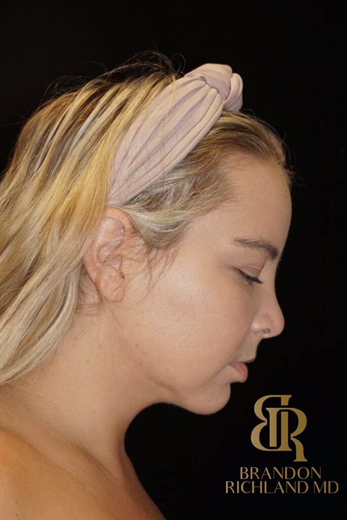 Liposuction After, Patient 02, view 4 — Dr. Brandon Richland, Newport Beach