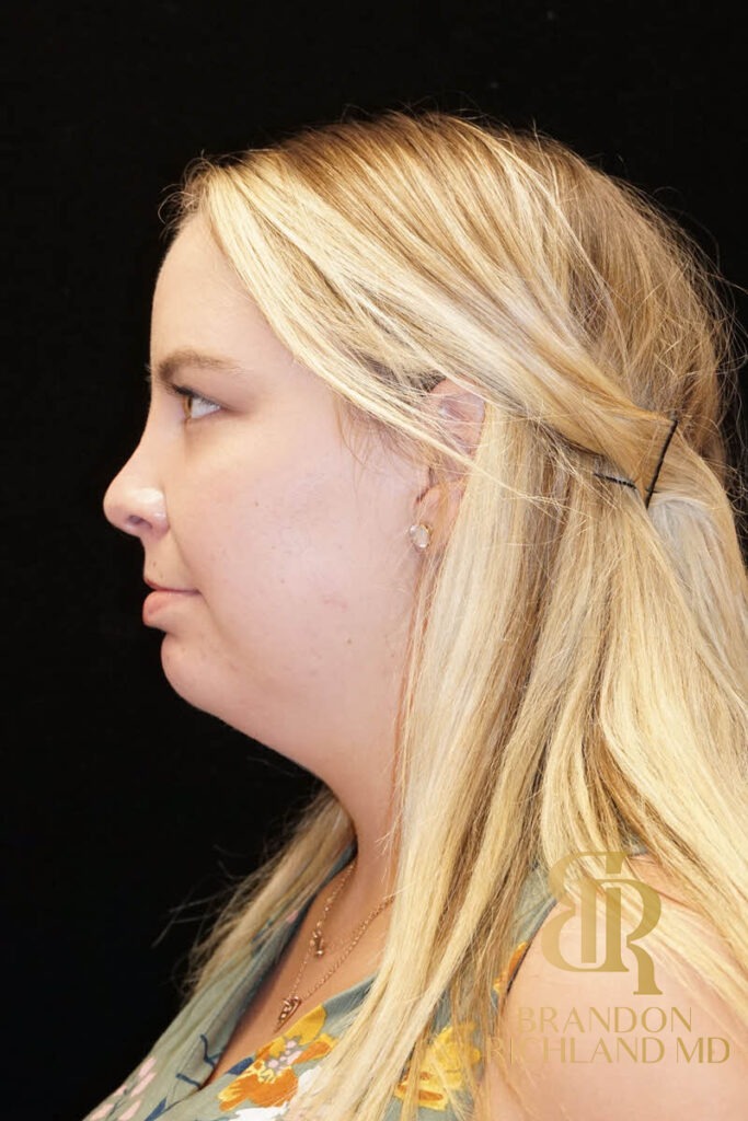 Liposuction Before, Patient 02, view 6 — Dr. Brandon Richland, Newport Beach