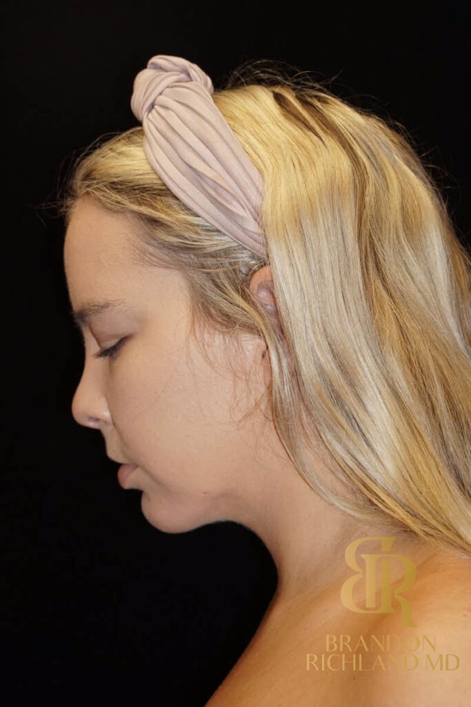 Liposuction After, Patient 02, view 7 — Dr. Brandon Richland, Newport Beach