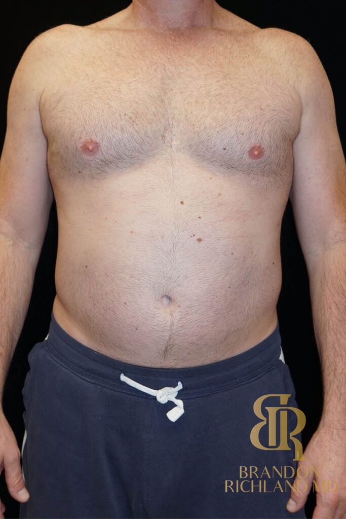 Liposuction Before, Patient 03, view 1 — Dr. Brandon Richland, Newport Beach