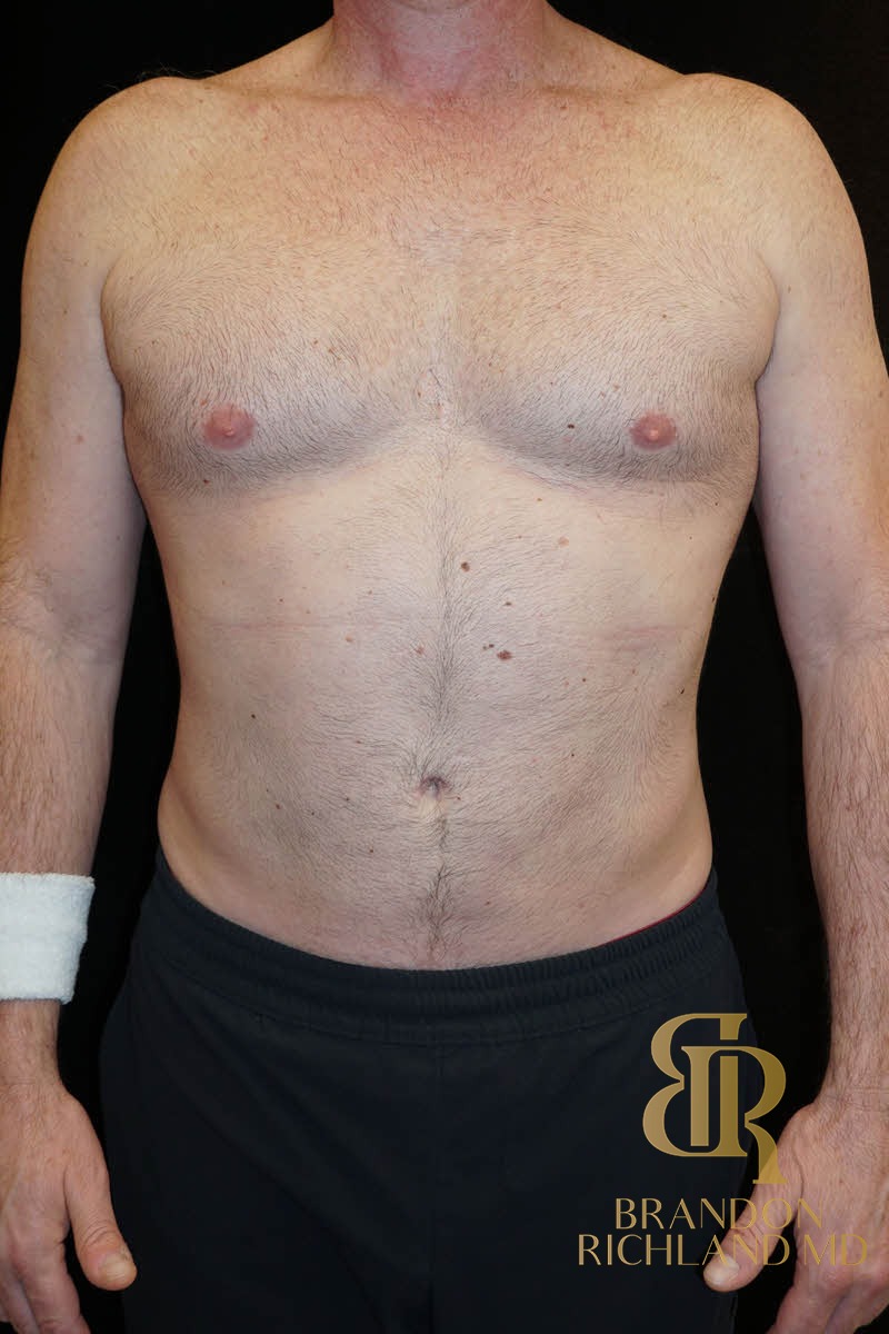 Liposuction before and after, Patient 03 — Dr. Brandon Richland, Newport Beach