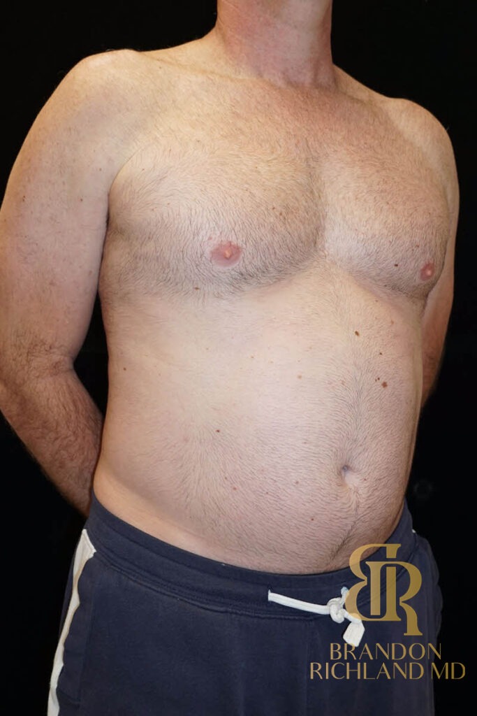 Liposuction Before, Patient 03, view 2 — Dr. Brandon Richland, Newport Beach