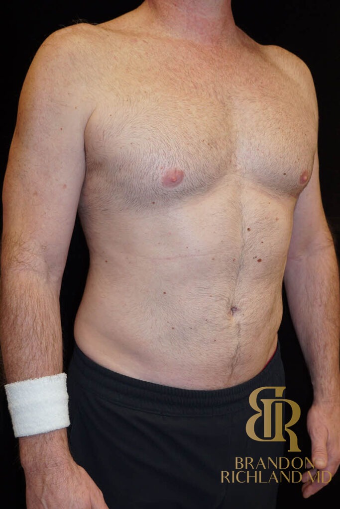 Liposuction After, Patient 03, view 2 — Dr. Brandon Richland, Newport Beach