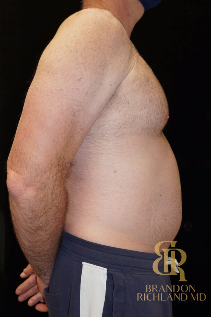 Liposuction Before, Patient 03, view 3 — Dr. Brandon Richland, Newport Beach