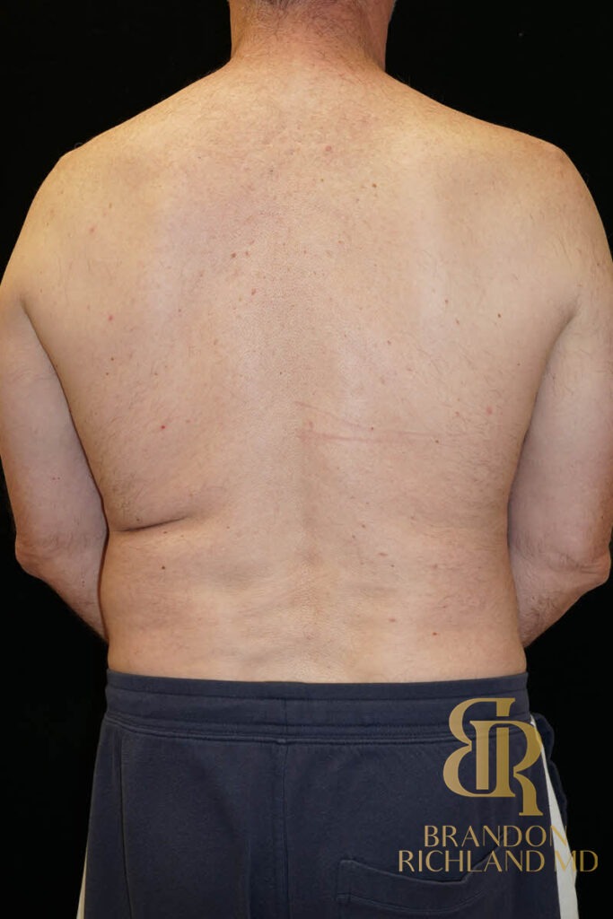 Liposuction Before, Patient 03, view 4 — Dr. Brandon Richland, Newport Beach