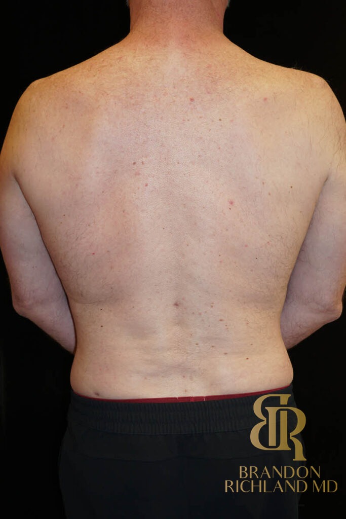 Liposuction After, Patient 03, view 4 — Dr. Brandon Richland, Newport Beach